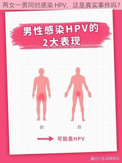 两女一男同时感染 HPV，这是真实事件吗？