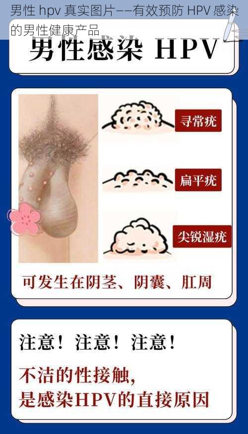 男性 hpv 真实图片——有效预防 HPV 感染的男性健康产品