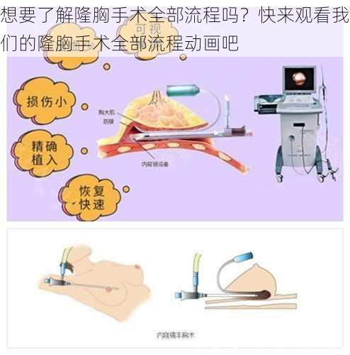 想要了解隆胸手术全部流程吗？快来观看我们的隆胸手术全部流程动画吧