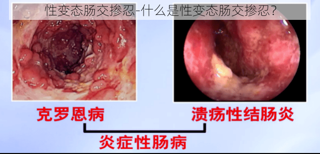性变态肠交掺忍-什么是性变态肠交掺忍?